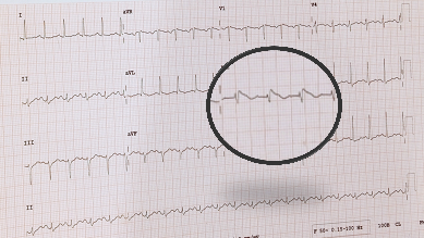 Fever-induced Brugada